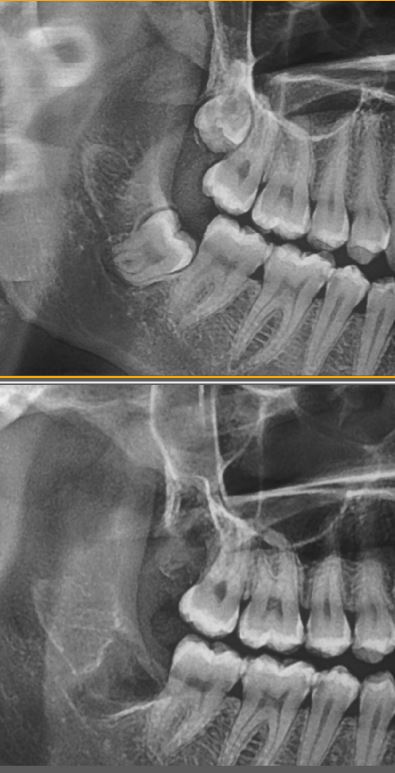 YİRMİ YAŞ DİŞ ÇEKİMİ