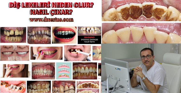 Sigara lekeleri nasıl çıkar?