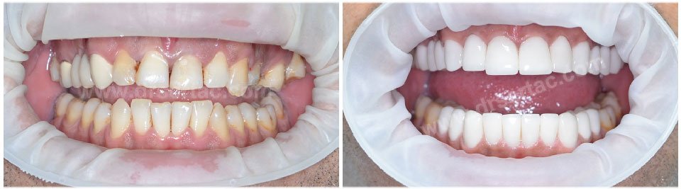 Estetik ön diş kaplama rengi için en bayaz diş rengi tercih edilmeli mi?