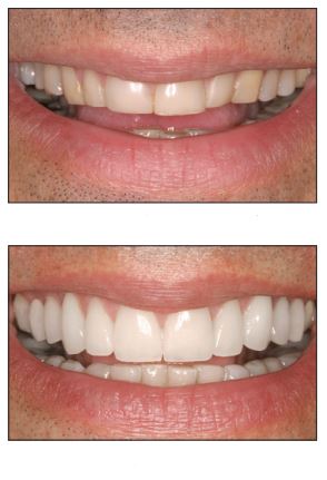 DİŞ KAPLAMA ÖNCE SONRA