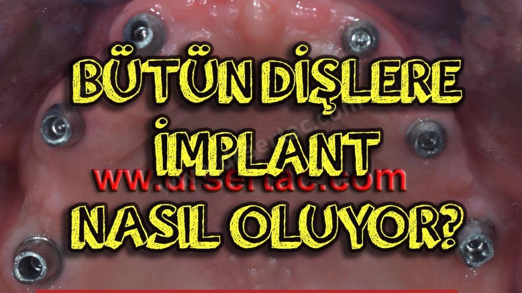 Bütün dişleri implant yaptırmak